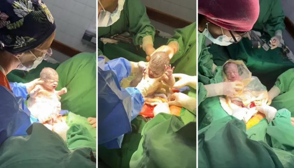 Nacen trigemelas monocoriales en Salta, un caso excepcional que asombra a la comunidad médica