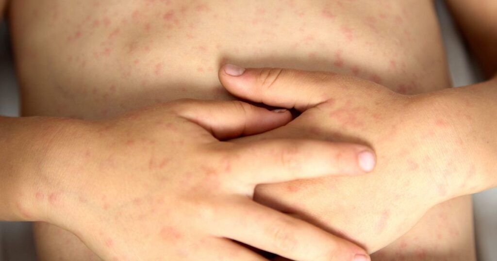 El Ministerio de Salud adelanta la segunda dosis de sarampión a los 18 meses