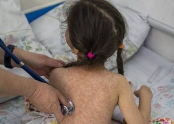 La Provincia cerró el brote de sarampión tras 20 semanas sin nuevos casos