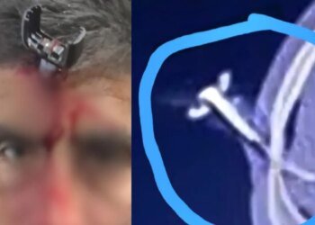 Grave ataque a futbolista: le clavan una llave en la cabeza en un torneo femenino en Berazategui