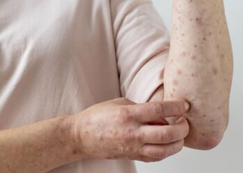 Alarma en la Provincia de Buenos Aires por nuevo brote de sarampión con 4 casos confirmados