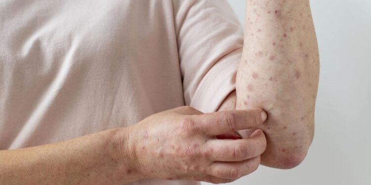 Alarma en la Provincia de Buenos Aires por nuevo brote de sarampión con 4 casos confirmados