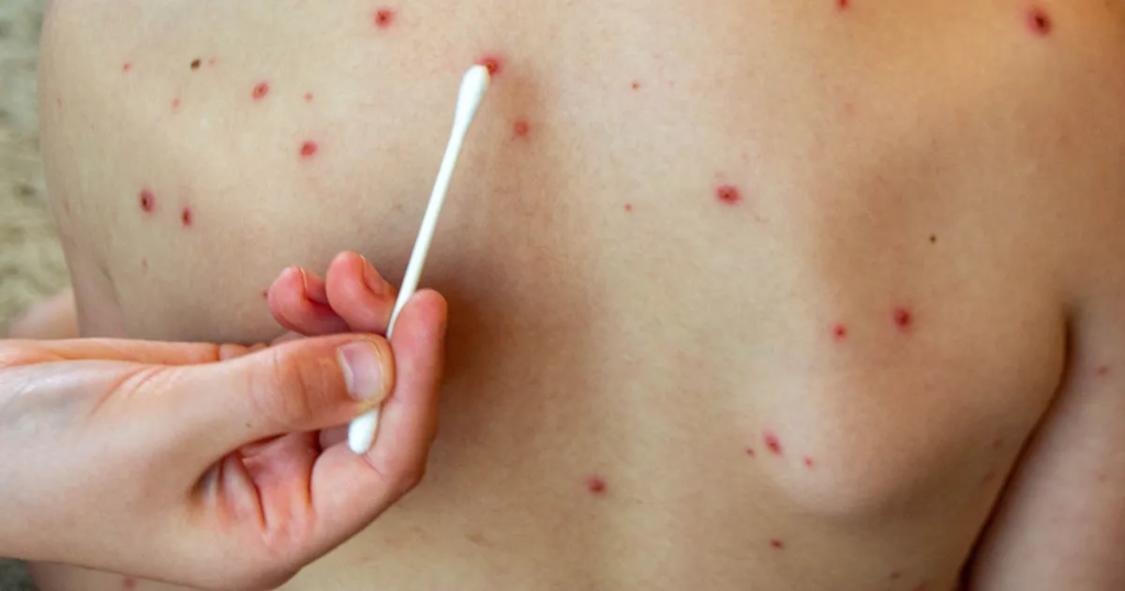 Cierra el brote de sarampión en la provincia de Buenos Aires tras 20 semanas sin nuevos casos