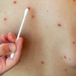 Cierra el brote de sarampión en la provincia de Buenos Aires tras 20 semanas sin nuevos casos