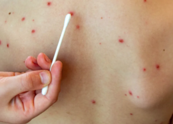 Cierra el brote de sarampión en la provincia de Buenos Aires tras 20 semanas sin nuevos casos