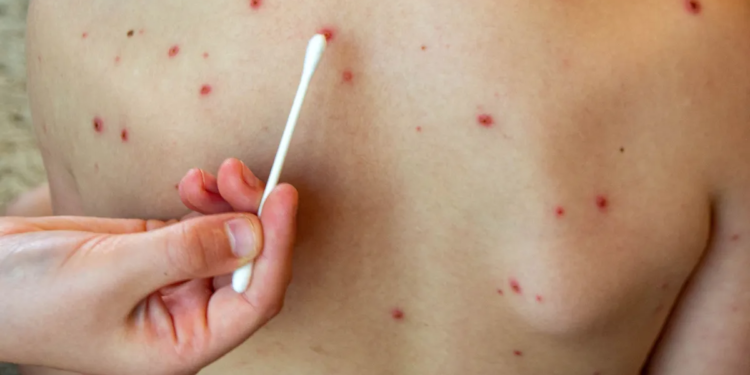 Cierra el brote de sarampión en la provincia de Buenos Aires tras 20 semanas sin nuevos casos