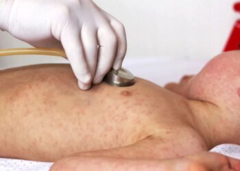 Alerta por repunte de sarampión en la Provincia de Buenos Aires tras fin de brote reciente