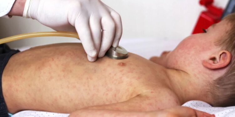 Alerta por repunte de sarampión en la Provincia de Buenos Aires tras fin de brote reciente