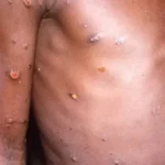 Confirman primer caso de viruela del mono variante Ib en Buenos Aires y refuerzan medidas sanitarias